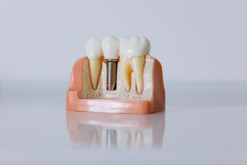 Dental Implant Placement Aftercare: A Guide