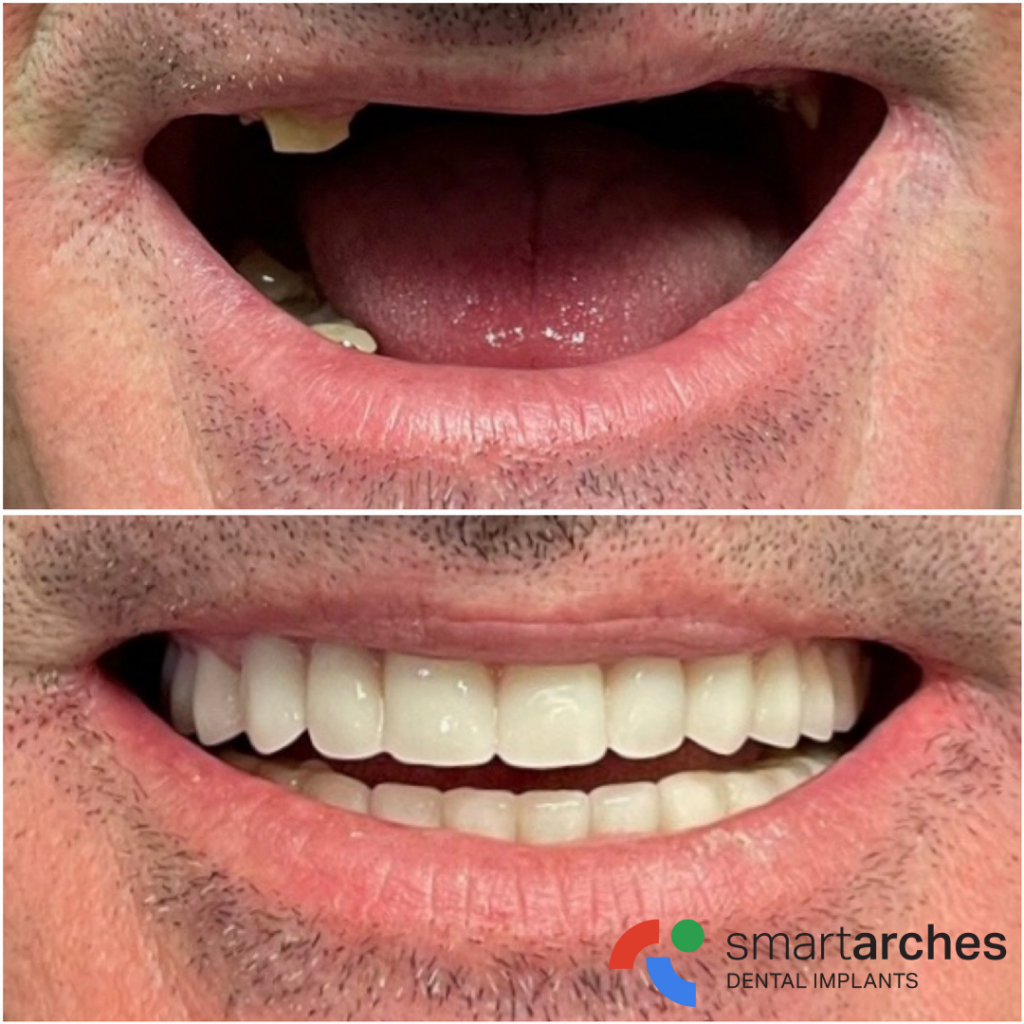 Smart Arches Dental Implant Center - After & After Photo