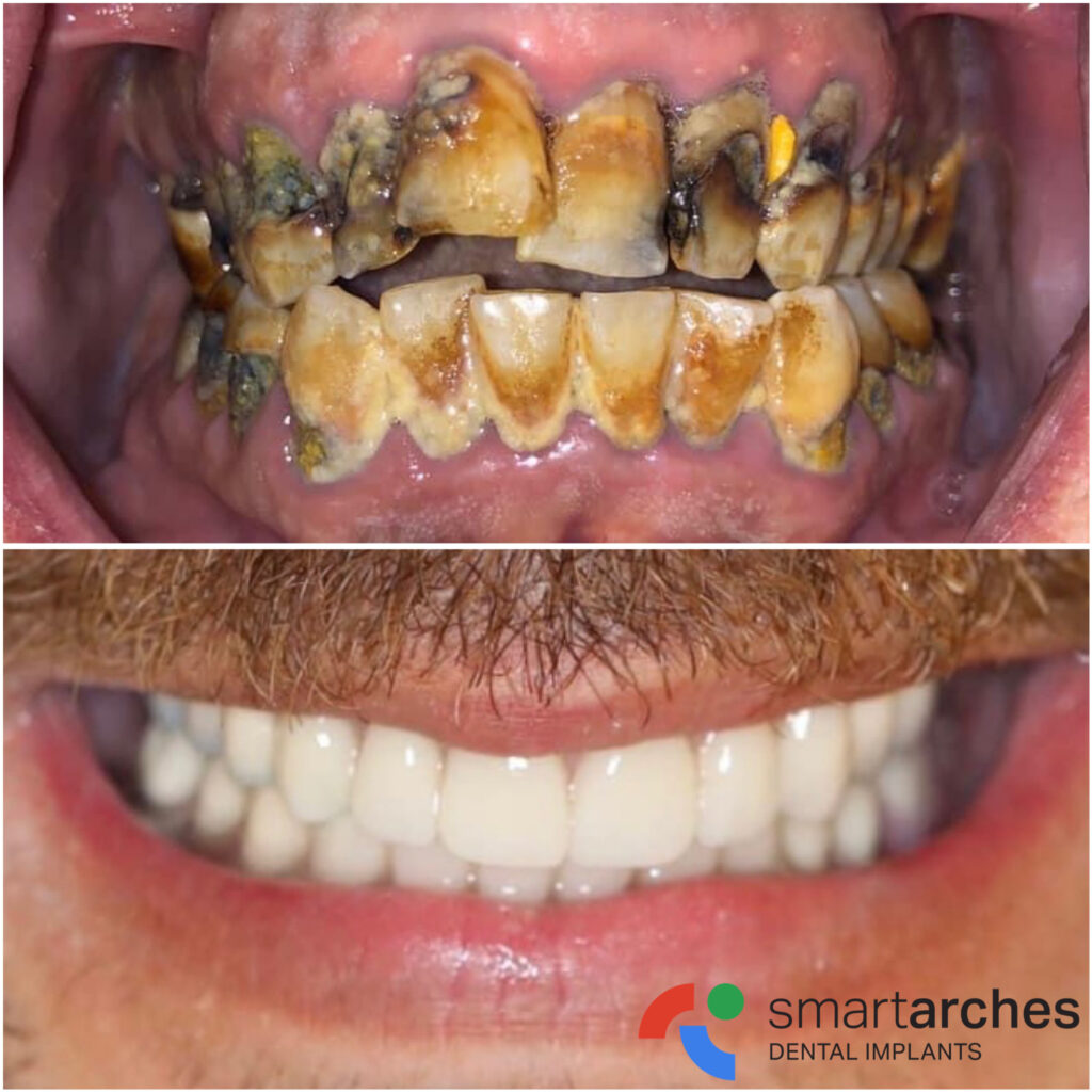 aSmart Arches Dental Implant Center - After & After Photo