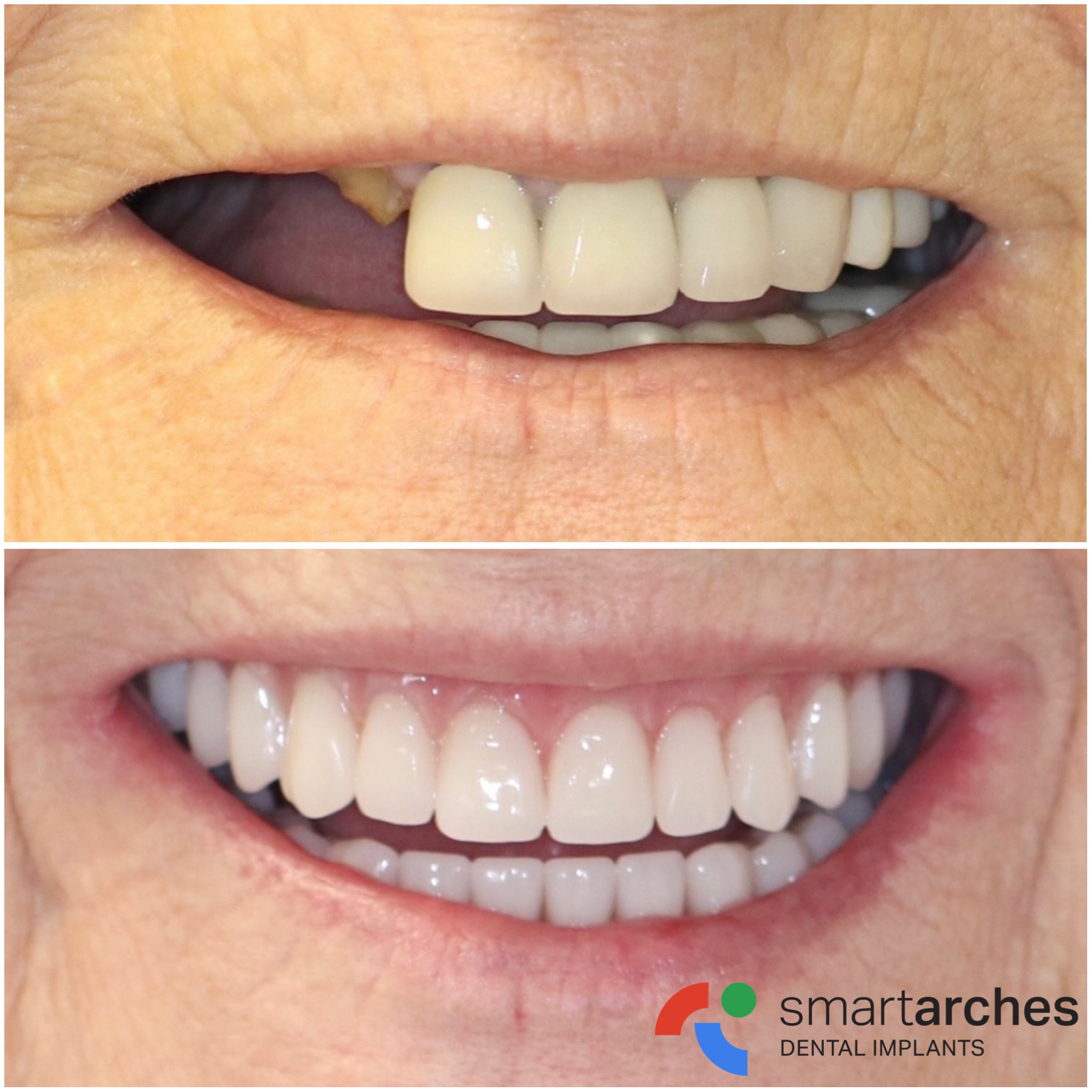 Smart Arches Dental Implant Center - After & After Photo
